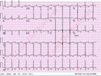 [ACC2011]危险心电图！！心电图基础知识